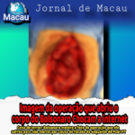 BOLSONARO MOSTRA IMAGEM DAS SUAS VÍCERAS INTESTINAIS DEVIDO À FACADO DA ESQUERDA PARA MATAR ELE