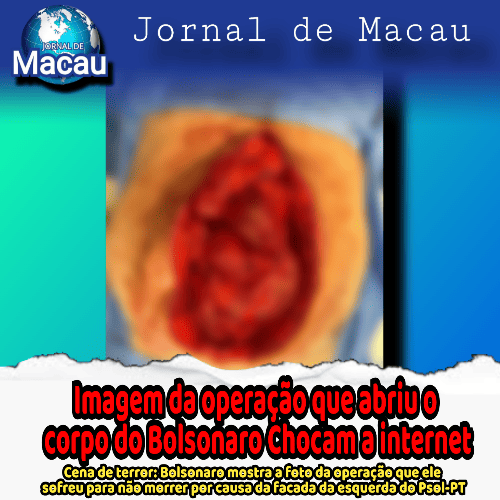 BOLSONARO MOSTRA IMAGEM DAS SUAS VÍCERAS INTESTINAIS DEVIDO À FACADO DA ESQUERDA PARA MATAR ELE
